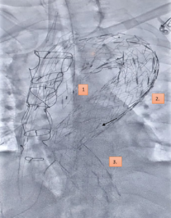 Fluoroscopy image showing all three aortic stents (numbered) in situ after the successful deployment of the third stent in the redo thoracic endovascular aortic repair procedure, completely bypassing the blood flow in the pseudo aneurysm of the arch of aorta.