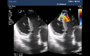 Two-dimensional transesophageal echocardiographic deep transgastric color compared view showing ventricular septal rupture in the mid-to-apical septum.