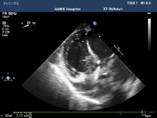 Two-dimensional transesophageal echocardiographic deep transgastric color compared view measuring ventricular septal rupture size 1.11 cm.