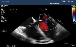 Two-dimensional transesophageal echocardiographic midesophageal four-chamber view revealed trivial mitral regurgitation.