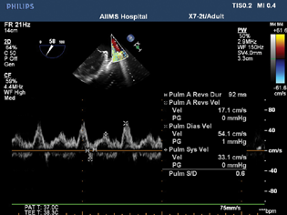 Two-dimensional transesophageal echocardiographic midesophageal pulmonary vein view with pulse wave Doppler showed systolic blunting with S/D 0.6