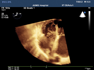 Live three-dimensional echocardiography in deep transgastric view demonstrated ventricular septal rupture in the mid-to-apical septum.