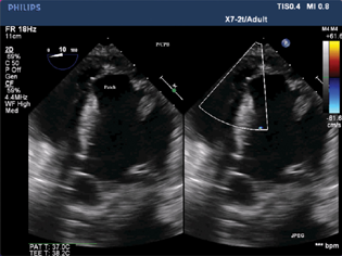 Two-dimensional transesophageal echocardiographic deep transgastric color compared view showing patch closure of ventricular septal rupture.