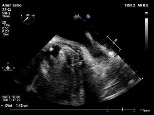 Mid-esophageal aortic short axis view showing the size of the aortic paravalvular leak around the noncoronary cusp.