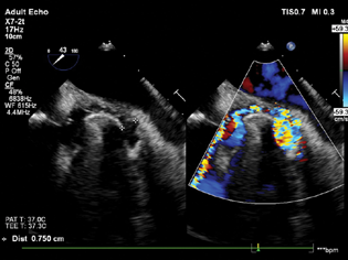 Mid-esophageal aortic short axis view showing the size of the paravalvular leak around the left coronary cusp.