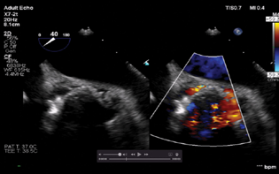 Mid-esophageal aortic short axis view showing cessation of the paravalvular leak.