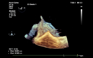 3D TEE showing exact site and dimension of the paravalvular leak.