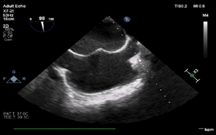 Mid-esophageal bi-caval view showing trans septal puncture of the guide wire.