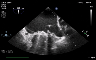 Mid-esophageal two-chamber view demonstrating the guide wire in the left atrium.