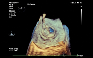 3D TEE image showing the position of the guide wire crossing through the prosthetic mitral valve.