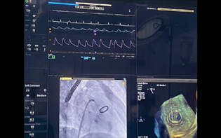 Full assembly showing a simultaneous display of hemodynamic fluoroscopy as well as TEE imaging for successful delineation of the anatomy of the paravalvular leak.