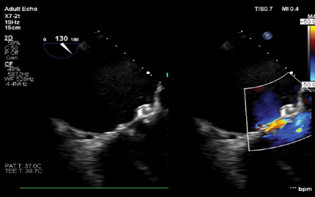 Mid-esophageal long axis view showing successful closure of the paravalvular leak.