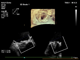 Full-volume 3D images taken after the closure of the paravalvular leak, showing no residual paravalvular leak.