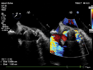 Mid-esophageal aortic short axis view showing significant paravalvular leak around the aortic valve.