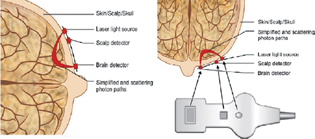 Cerebral oximetry sampling of tissue from two photodetectors.