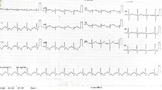 Normalisation of heart rate and axis on ECG after verapamil infusion.
