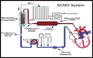 The typical extracorporeal membrane oxygenation (ECMO) circuit.