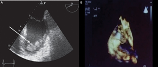 Intraventricular thrombosis is a well-known complication of myocardial infraction. Extracorporeal membrane oxygenation (ECMO) and left ventricular akinesis can increase this risk (A) seen in an ECHO picture as thrombus or cast embolus or cause flow obstruction to superior vena cava/inferior vena cava (B). Complications of ECMO may vary from and result from rupture or dysfunction of any ECMO circuit component.