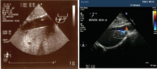 Obstruction of the inferior vena cava.