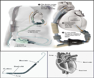 Impella and HeartMate I, two VADS in Global use.