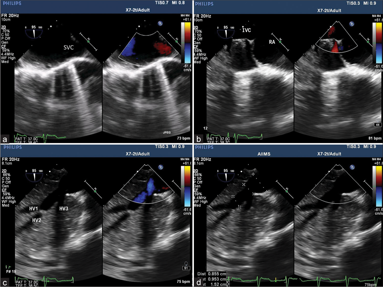 (a) Midesophageal bicaval view with color comparison demonstrating superior vena cava and (b) inferior vena cava (IVC) draining into the right atrium. (c) Transgastric hepatic vein (HV) view confirming 3 HV draining into IVC and (d) HV confluence and IVC measuring 0.9 cm and 1.5 cm, respectively.