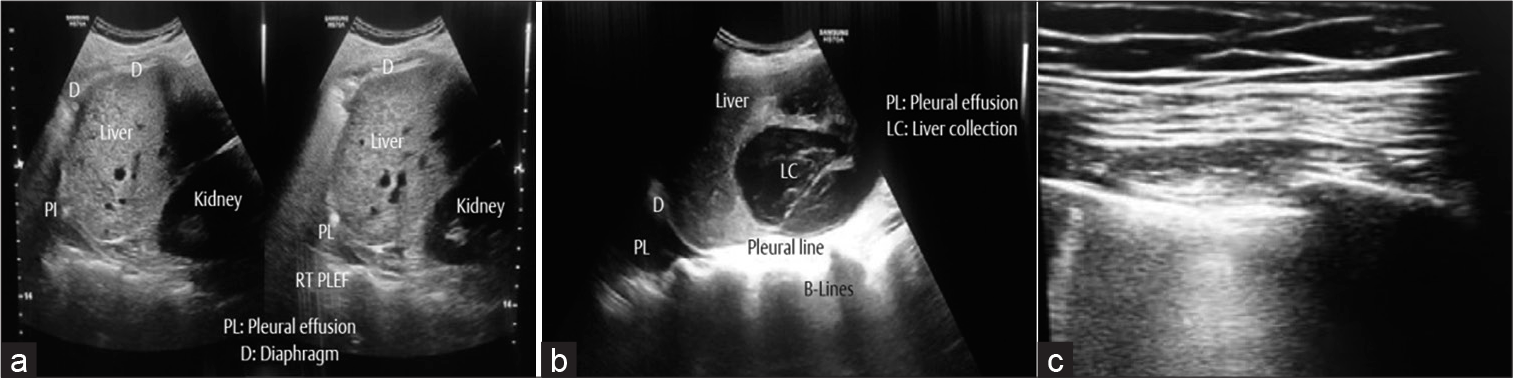 (a) Point-of-care ultrasound (POCUS) showing the relations of right lung, liver, and right kidney. A small right-sided pleural effusion. (b) POCUS showing large hepatic collection and a right-sided pleural effusion. (c) Confluent multiple B-lines suggesting pneumothorax on extracorporeal membrane oxygenation.