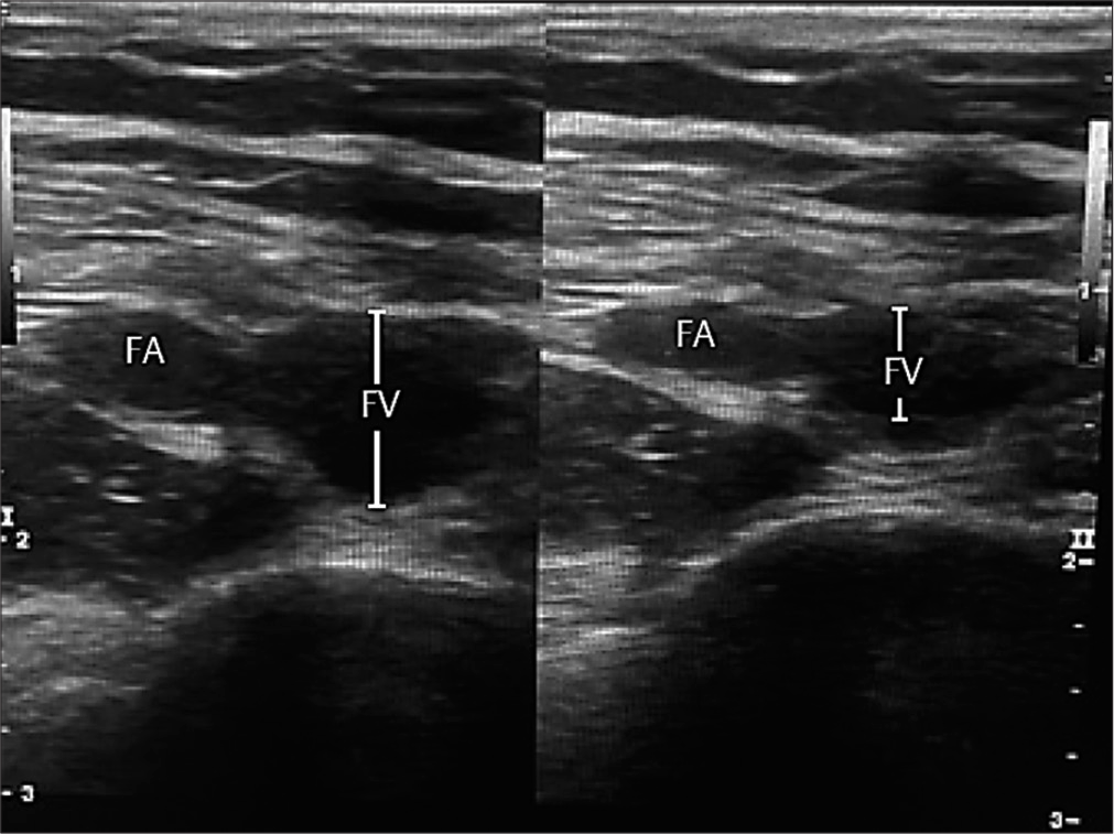 Compressible femoral vein indicates absence of deep venous thrombosis.