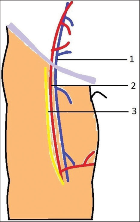 Anatomical relationship of femoral vein, and femoral nerve at the groin. (1: Femoral Vein, 2: Femoral Artery and 3: Femoral Nerve).