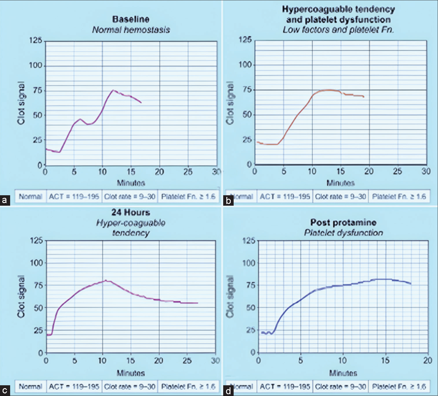 (a-d) Sonolcot curve with platelet dysfunction in a Tetralogy of Fallot patient on venoarterial extracorporeal membrane oxygenation (ECMO) showing four different scenarios. (a) Normal hemostasis, (b) Low factors and poor platelet function, (c) Hypercoagulable tendency, signature curve on Sonoclot (d) Post-protamine for poor platelet function in a post-TOF patient on ECMO.