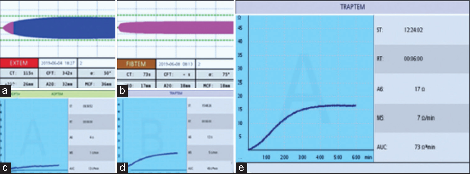 (a-e) The use of rotational thromboelastometry (ROTEM) based viscoelastic test (VET) and platelet function tests (PFTs) to guide and monitor the correct component therapy. Figure a and b are cases of heparin infusion needing only protamine, showcasing heparin influence which necessity stopping heparin and giving protamine. Anticoagulation in extracorporeal membrane oxygenation (ECMO), done on venoarterial ECMO patients, shows the importance of ROTEM-based VET such as CT EXTEM and ADPTEM PFTs to detect the bleeding causes and factor deficiency. (e) shows good area under the curve in 10 minutes using TRAPTEM PFT reagent. This implies good platelet function, so no platelet transfusion is needed.