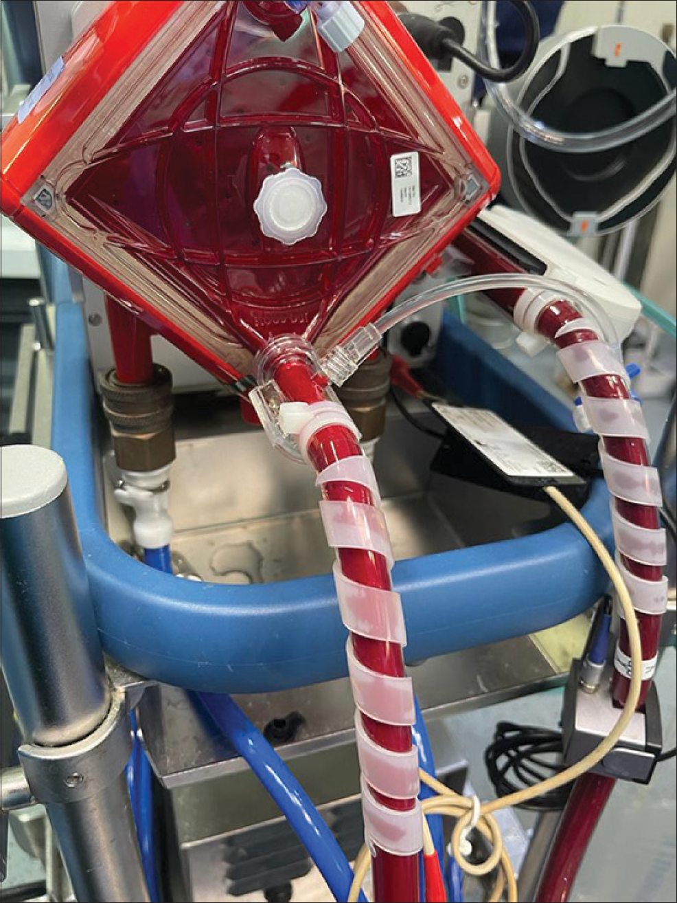 Bivalirudin thrombosis in the veno arterial extracorporeal membrane oxygenation (ECMO) Circuit seen with bivalirudin anticoagulation with cardiohelp oxygenator patient, a known case of HITT survived by stopping all anticoagulation and changing the ECMO circuit.