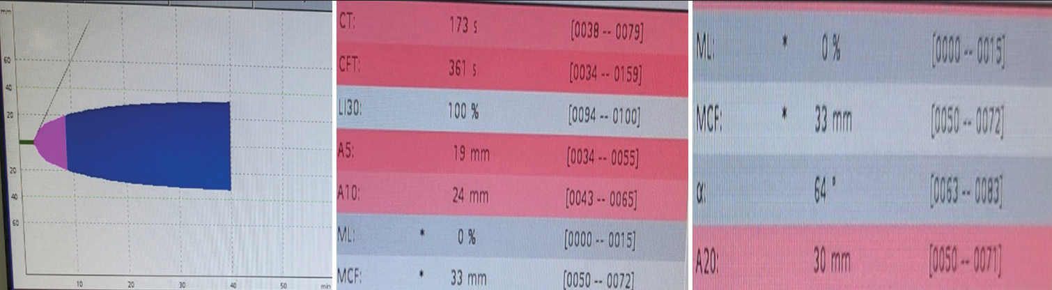 ROTEM in bivalirudin thrombosis: EXTEM parameters showed a prolonged clotting time of 173 s, clot formation time of 361 s and decreased A5, A10, and A20 parameters.