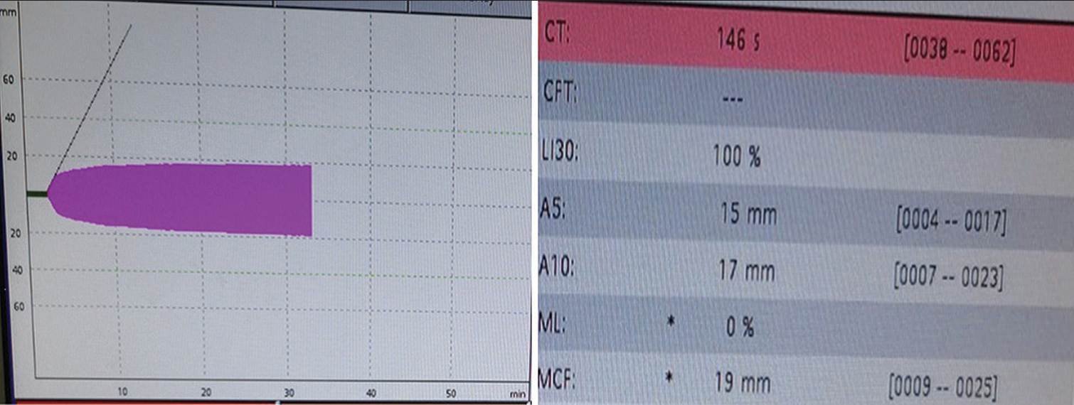 ROTEM in bivalirudin thrombosis: The FIBTEM analysis showed a prolonged clotting time of 146 s with a normal A5 and A10 of 15 mm and 17 mm, respectively, and an MCF value of 19 mm implying a good hemostatic reserve and pointing toward a thrombocytopenic picture.