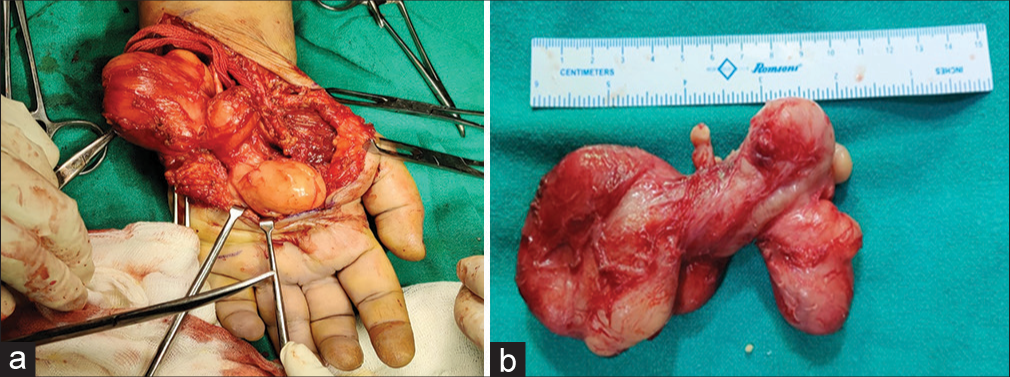 Surgical excision of the compound palmar ganglion. (a) With gross section and (b) it is the excised encapsulated mass.