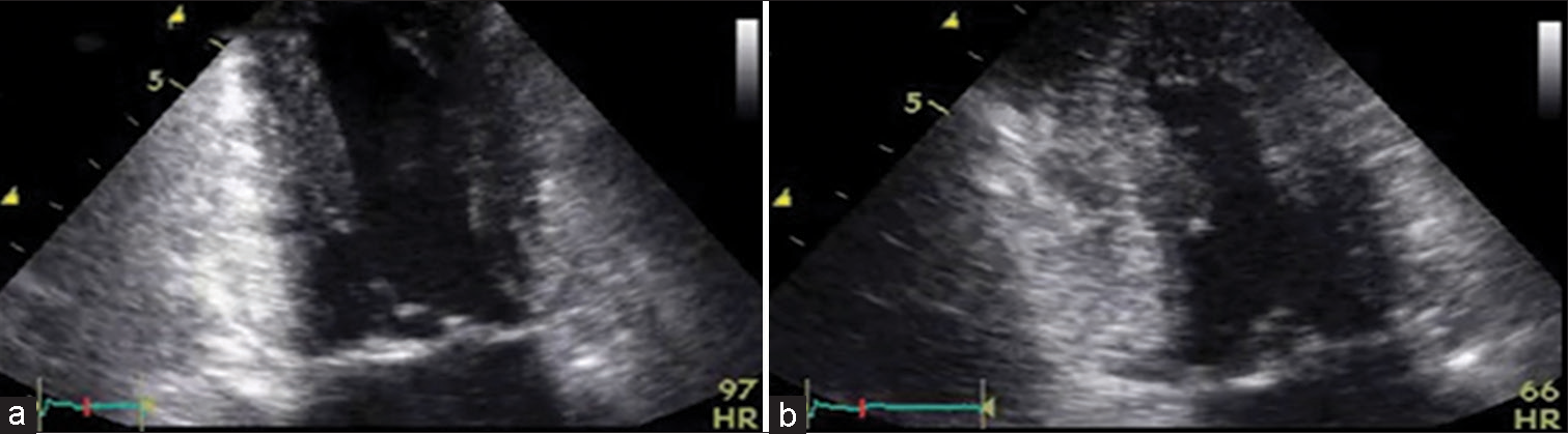 (a and b) A transthoracic echocardiogram showing decreased wall motion in midseptum and inferior lateral wall dyskinesia following acute myocardial infarction with tuberculosis.