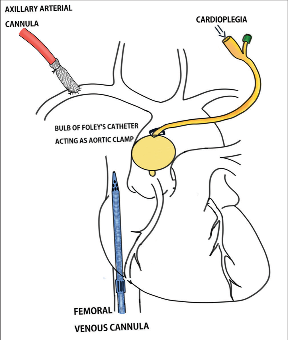 Schematic diagram depicting cannulation strategy and cardioplegia delivery.