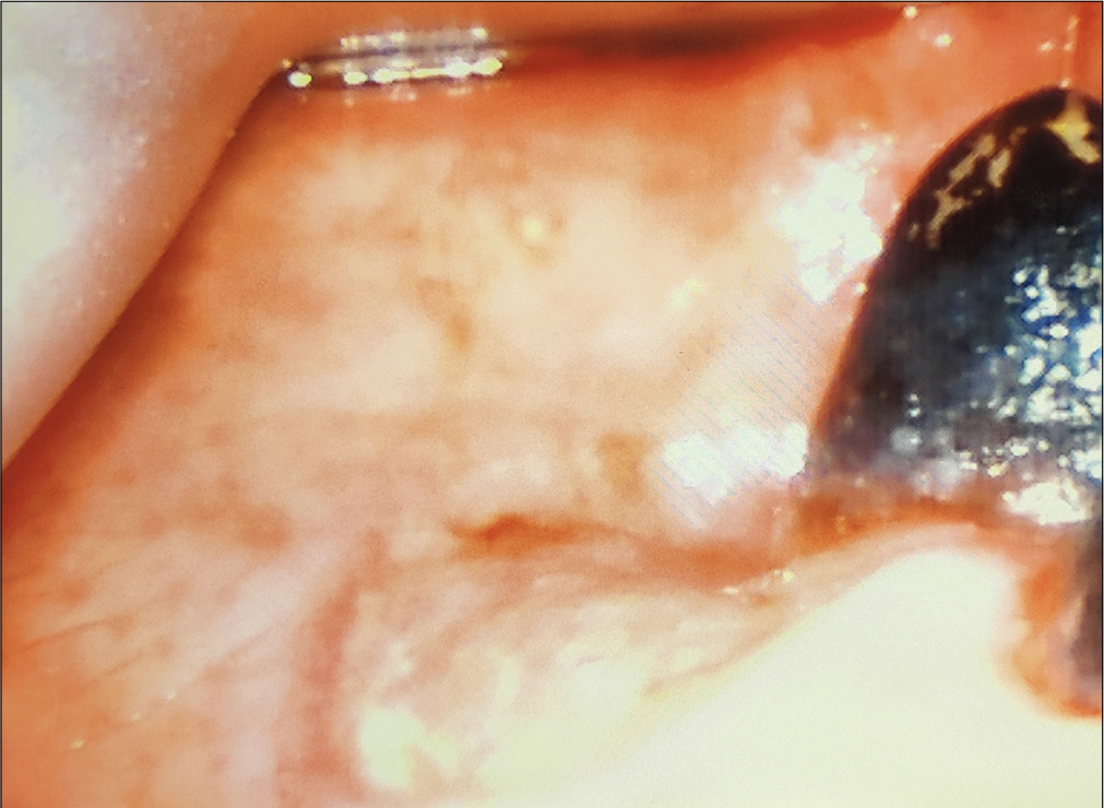 C-Mac video laryngoscopic view showing the friable buccal mucosa.