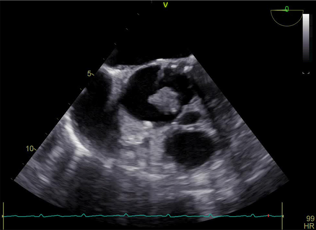 Mid esophageal aortic valve short axis echocardiographic view illustrating vegetation and a cavitary lesion in the junction of left and right coronary cusp.