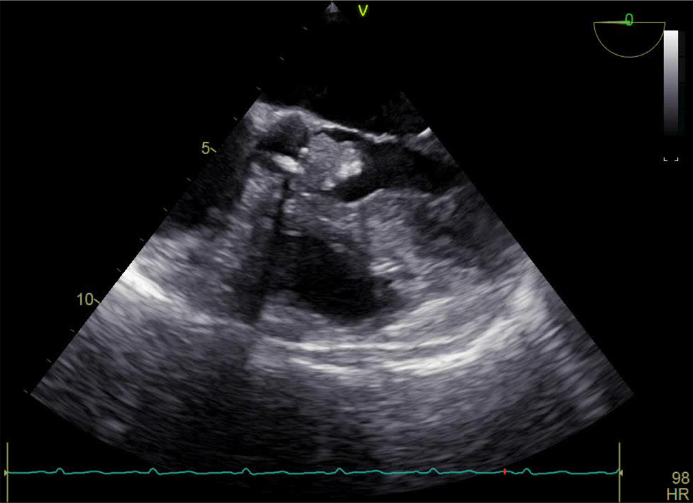 Mid esophageal five-chamber view, demonstrating vegetation arising from aortic valve.