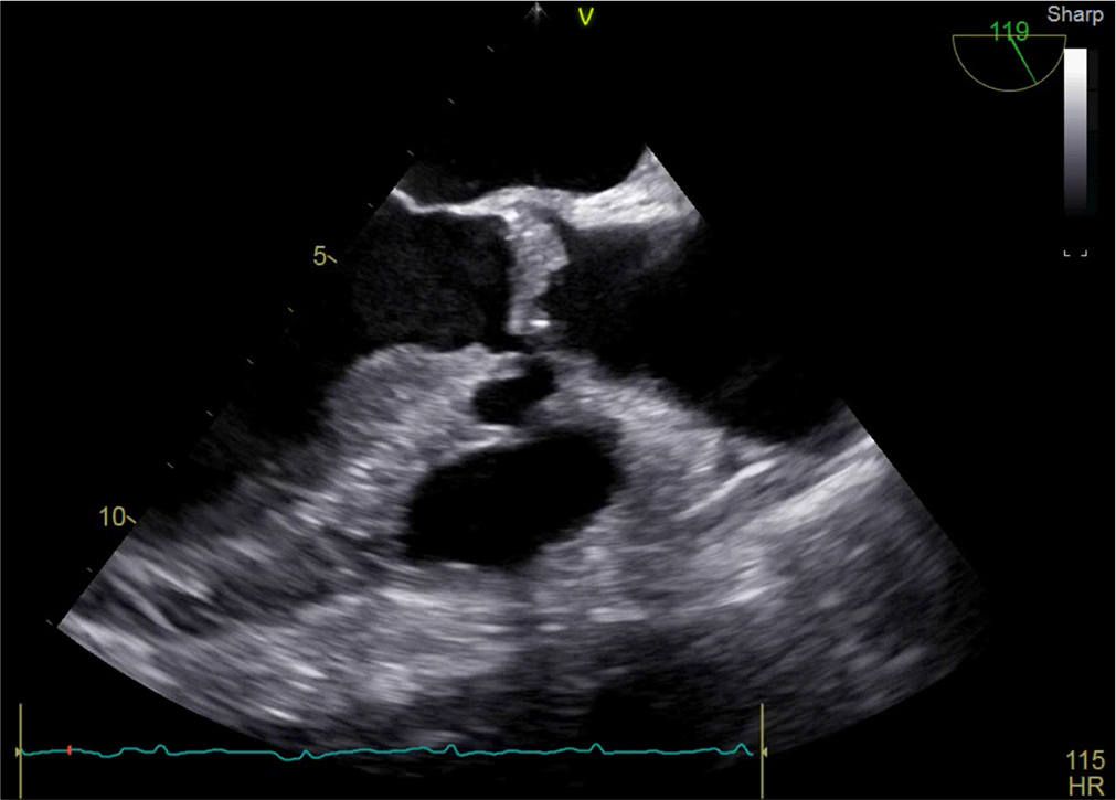 Mid esophageal aortic valve (AoV) long axis view delineating vegetation, abscess cavity, and degenerative changes of AoV.