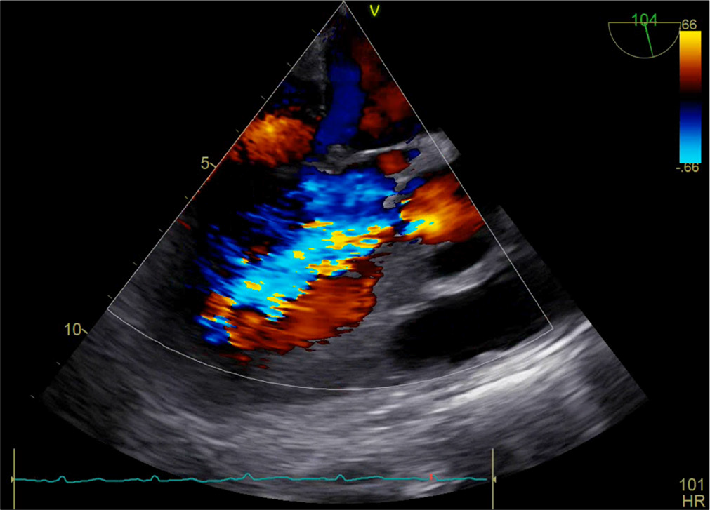 Mid esophageal, aortic valve (AoV), long axis view with color Doppler interrogation revealing flow turbulence across the AoV along with regurgitant jet.