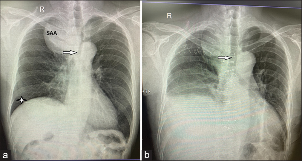 Chest X-ray (a) depicting a large subclavian artery aneurysm, compression and leftward shift of the trachea (arrow), and elevated right hemidiaphragm (star). (b) Showing the normal course of the trachea after surgery (arrow).