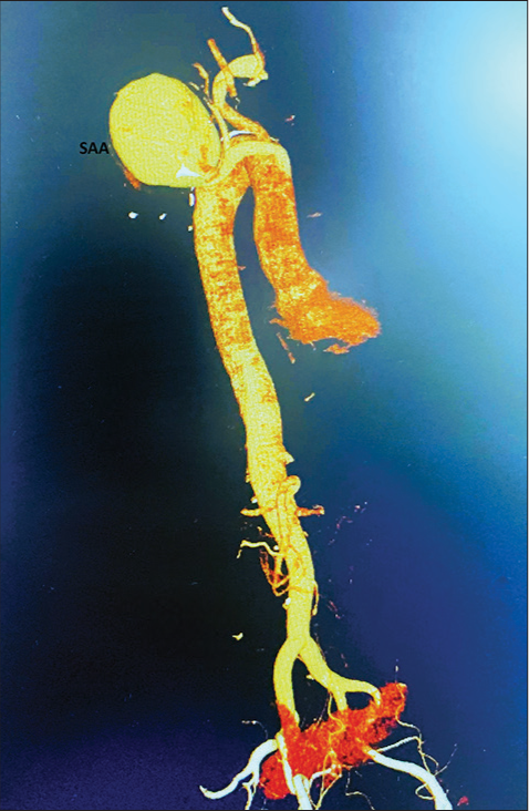 Computed tomographic angiogram demonstrating a large subclavian artery aneurysm.