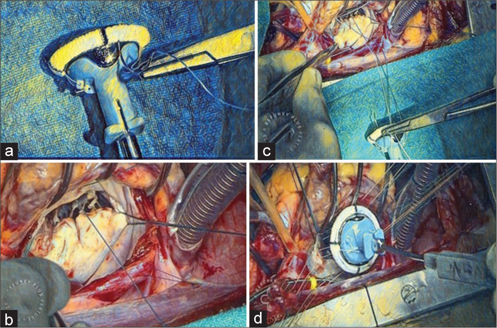 (a) Suture being placed at 12 o’clock position at the sewing ring. (b) Annulus suture taken at 12 o’clock position at mitral annulus. (c) Mechanical valve to mitral annulus suturing using interrupted suture technique. (d) Mechanical mitral valve being parachuted.