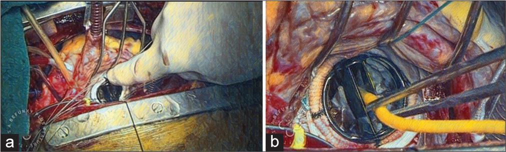 (a) Tying of mechanical mitral valve to the mitral valve annulus. (b) Frustration of the mechanical valve with Foley catheter.