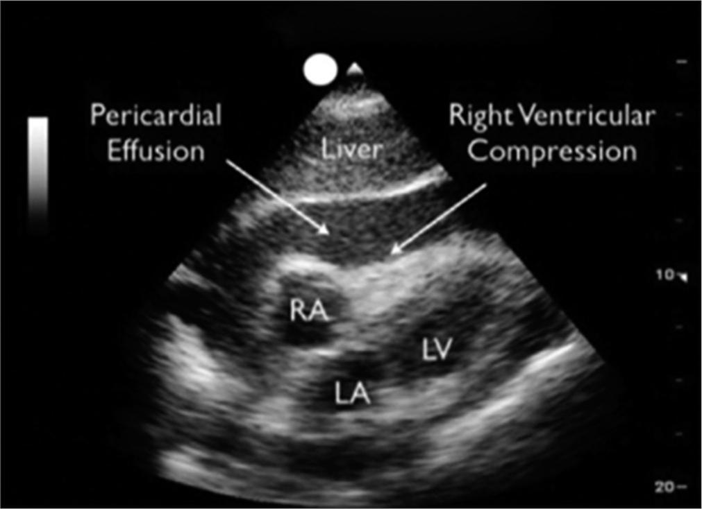 Pericardial tamponade detected by echocardiography when on extracorporeal membrane oxygenation (ECMO), RA: Right Atrium, LA: Left Atrium, LV: Left Ventricle.