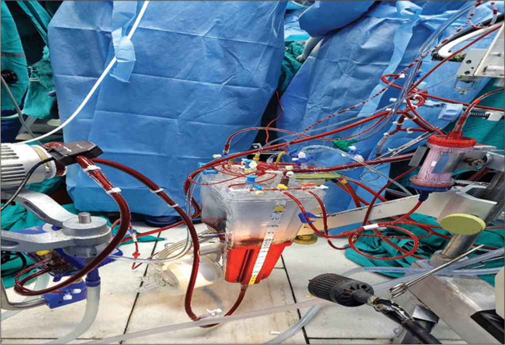 Integrated extracorporeal membrane oxygenation.