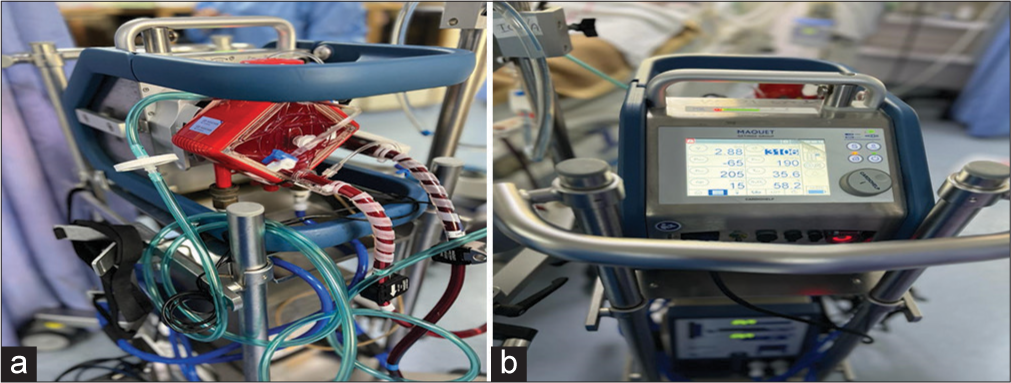 (a and b) Cardiac extracorporeal membrane oxygenation.