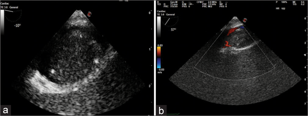 (a) Transgastric (TG) short axis showing Tumor thrombus in inferior vena cava (IVC) compromising majority of the lumen. (b) TG IVC long axis view with color flow Doppler showing a narrow streak of flow around the thrombus.