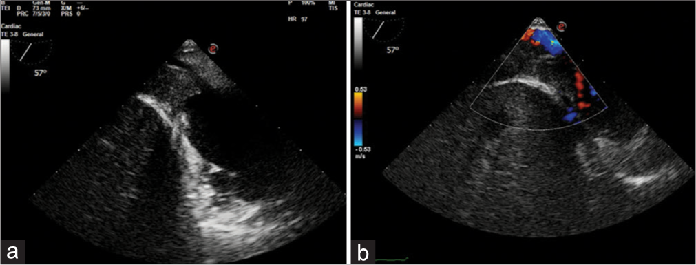 Transgastric long axis inferior vena cava (IVC) view with probe withdrawn to focus right atrium (RA)-IVC junction – (a) showing tumor extension till RA-IVC junction and compromise of IVC lumen. (b) Color flow Doppler imaging showing turbulent flow in IVC.